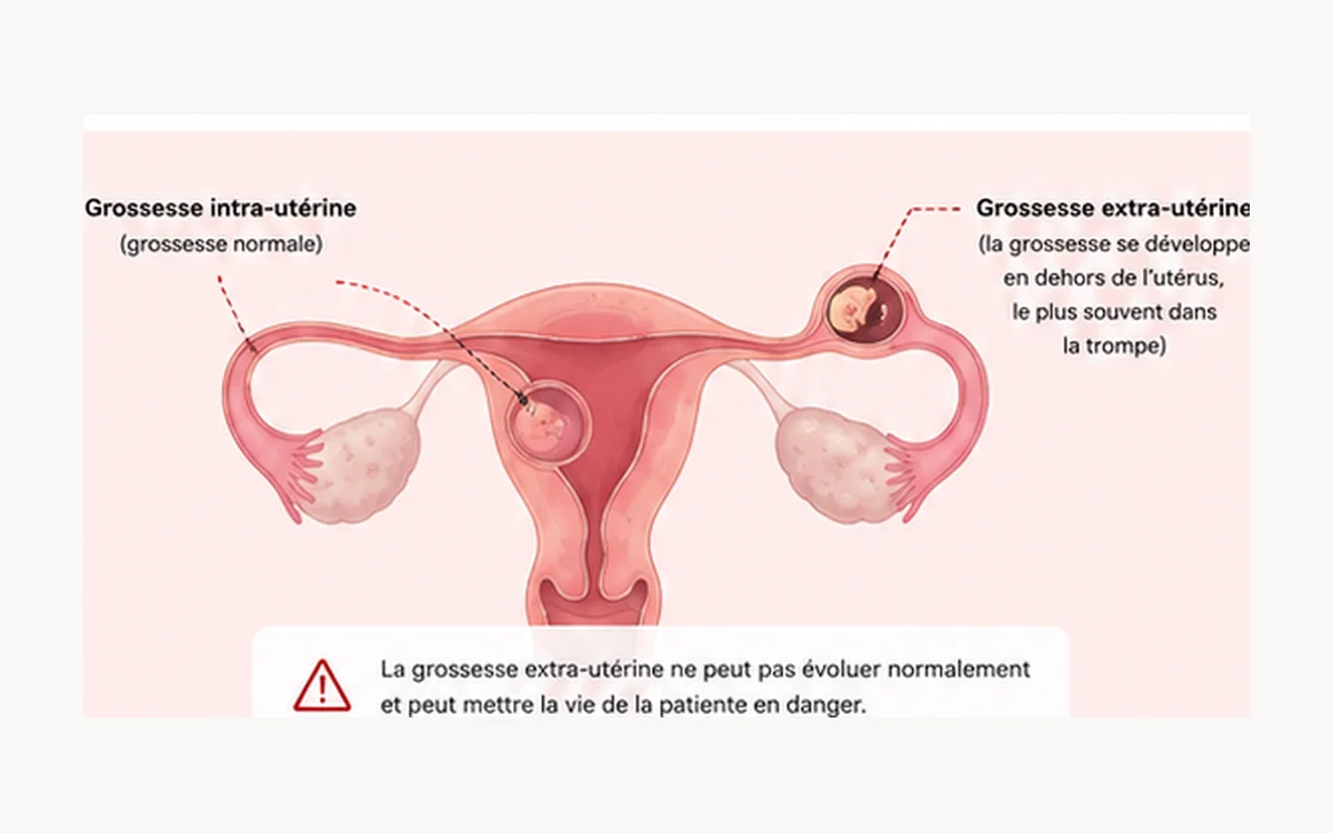 Grossesse extra-utérine : quels signes doivent alerter ?